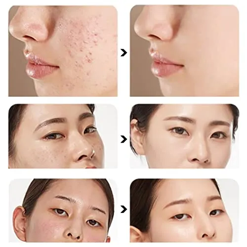 15g Acne Removal Cream, Moisturizing Acne Scars Treatment Cream Skin Repairing Cream, Fades Acne Spot, stubborn Scars, Pigmentation & Blemish