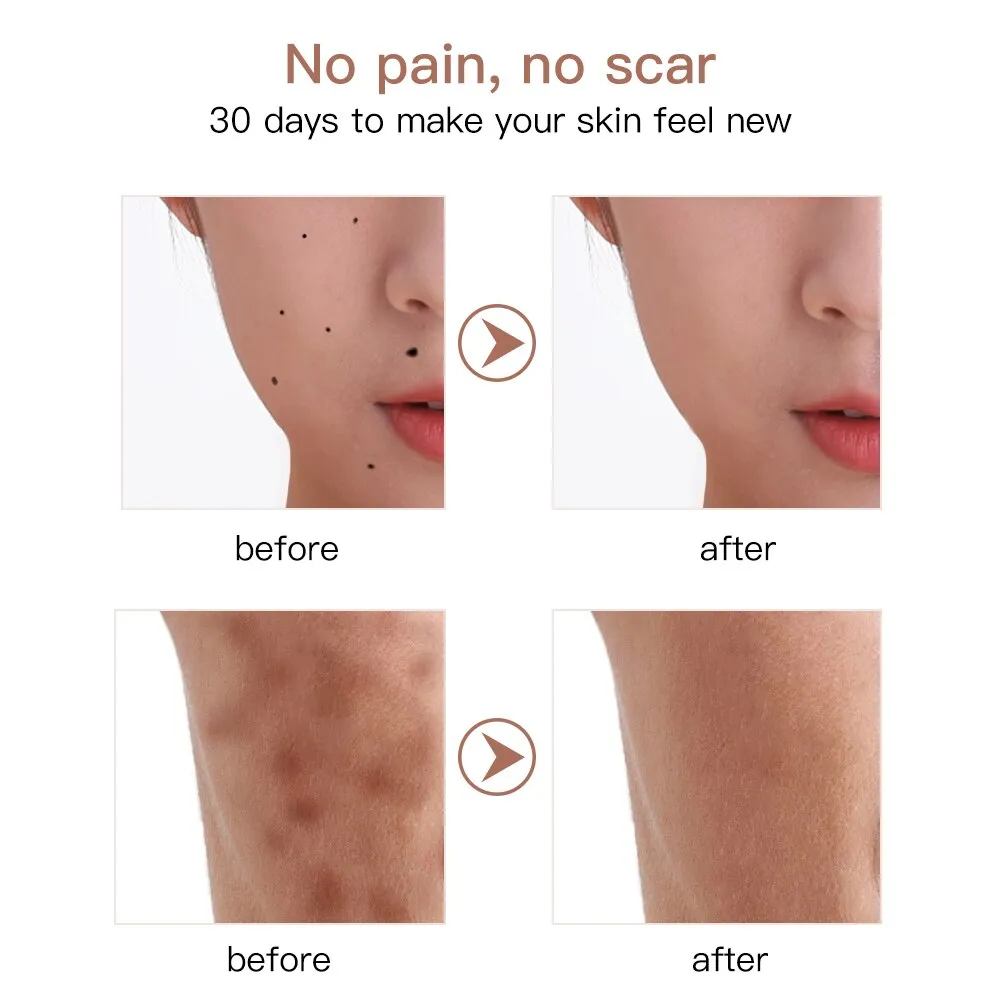 9 levels Laser Plasma Pen Mole Removal Dark Spot Remover LCD Skin Care