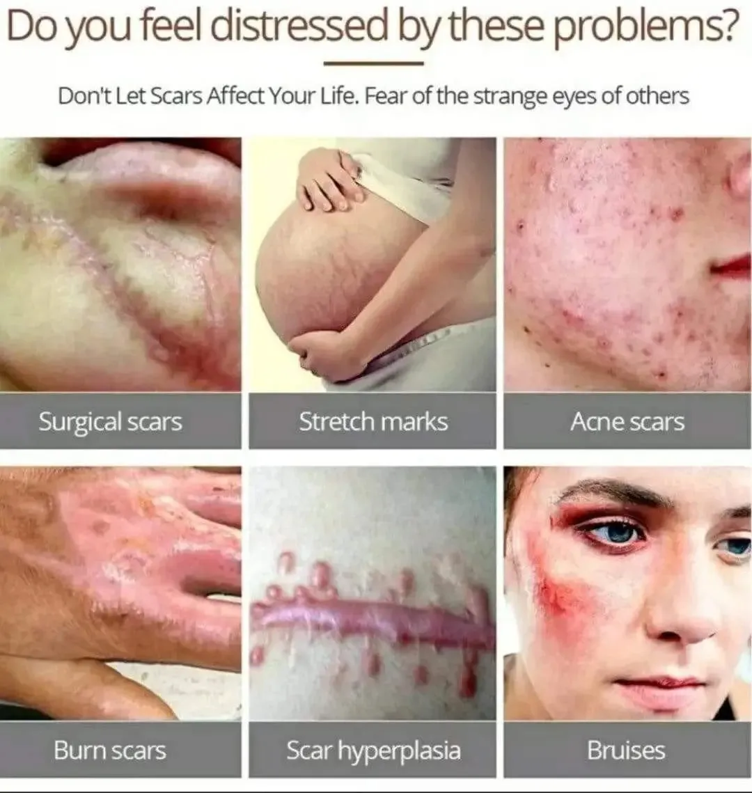 Acne & Scar Cream