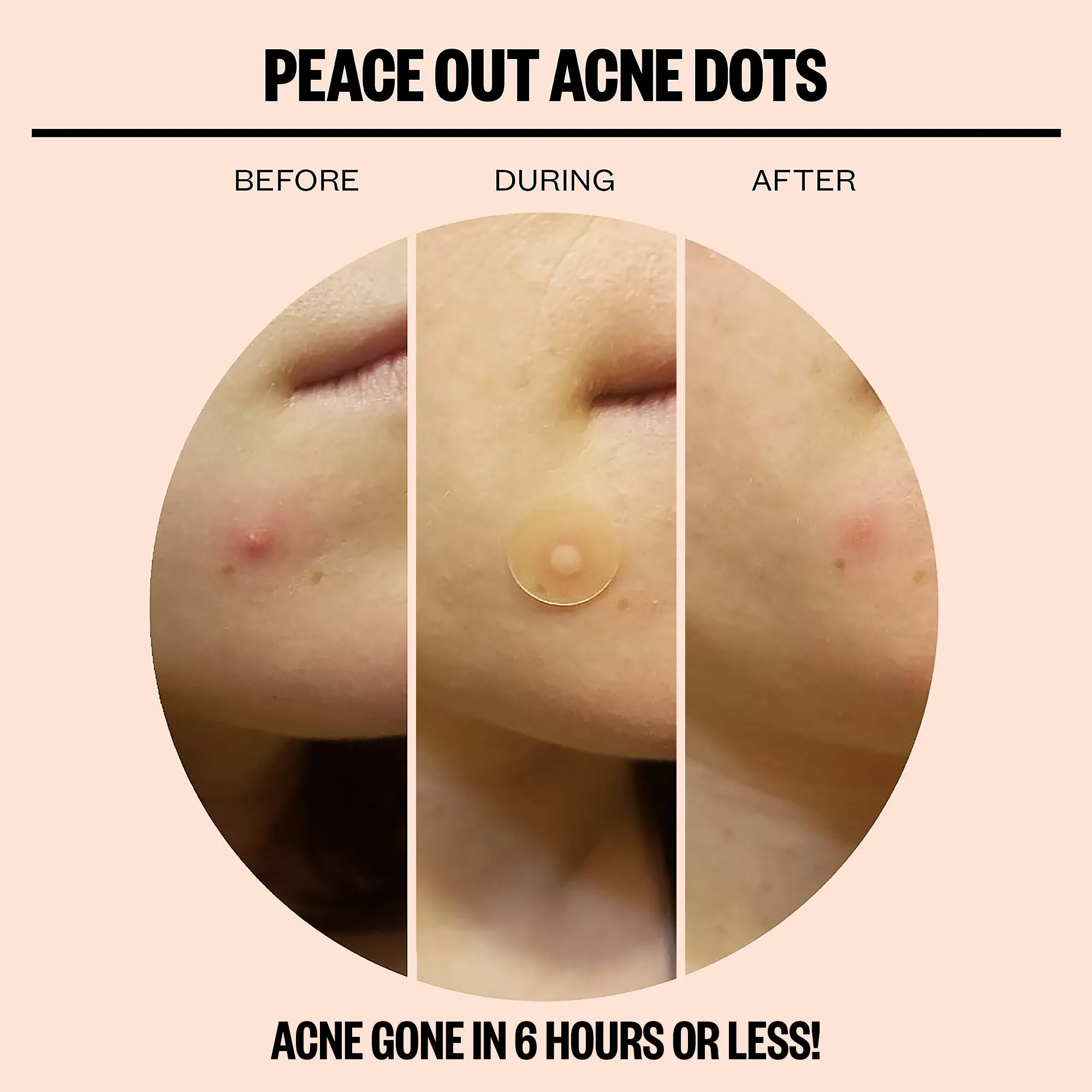 Acne Dots - 10 Pack