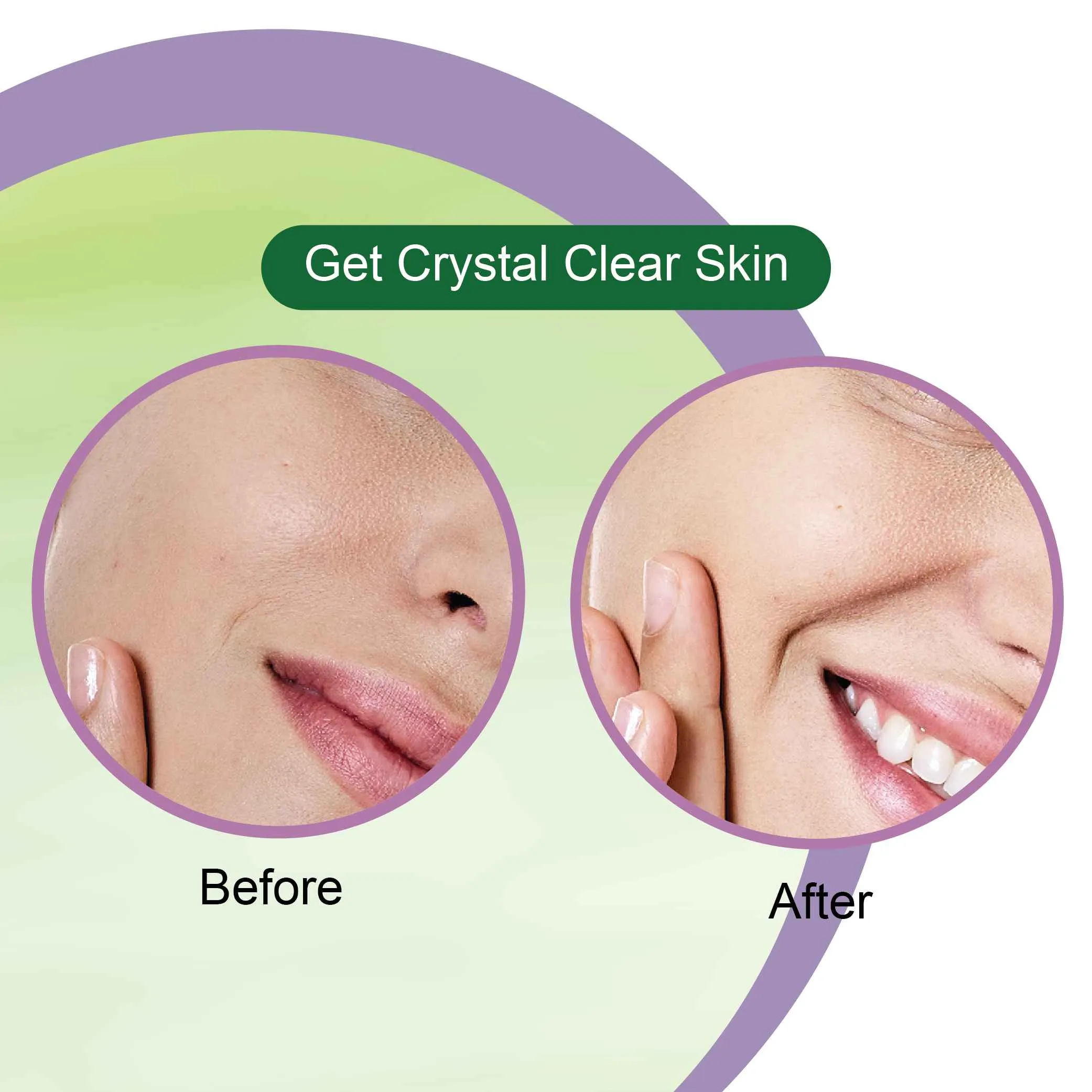 Anti-Acne Kit