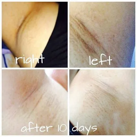 Beautederm Underarm Whitening Set