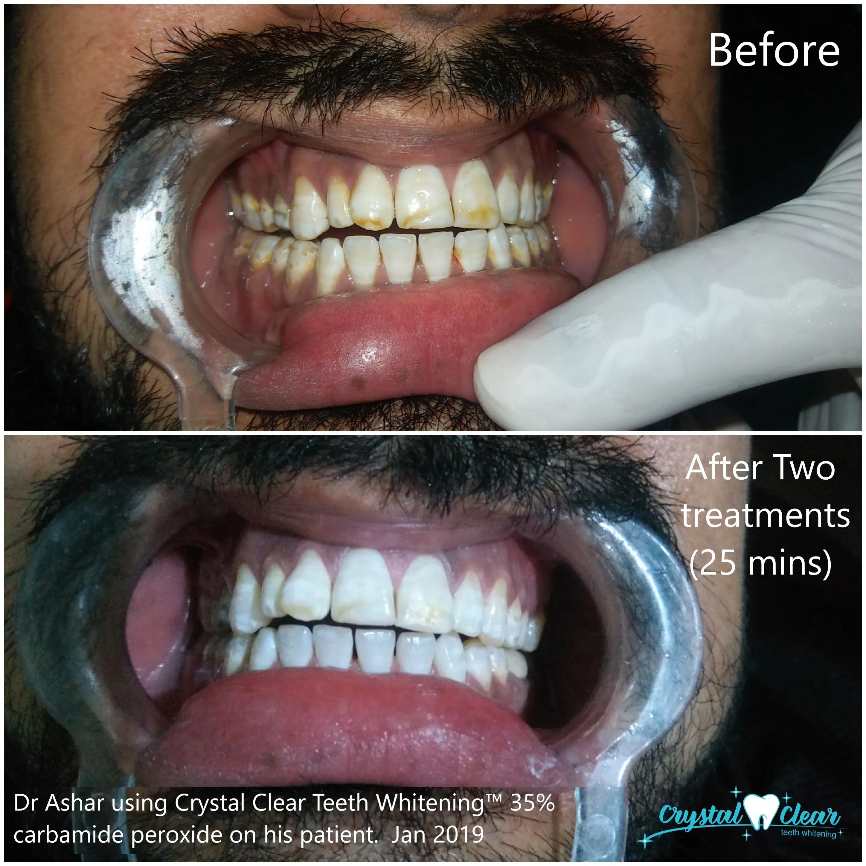 Crystal Clear Teeth Whitening Gel Refill - 5 Pack