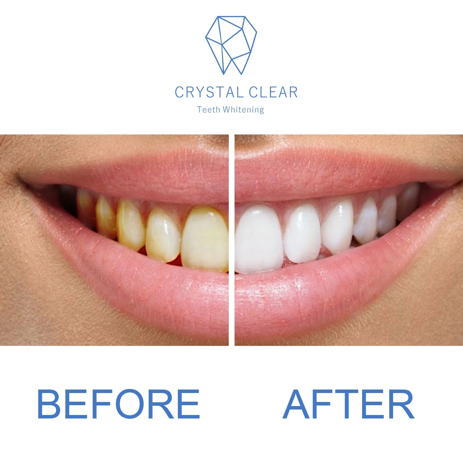 Crystal Clear Teeth Whitening Gel Refill - 5 Pack