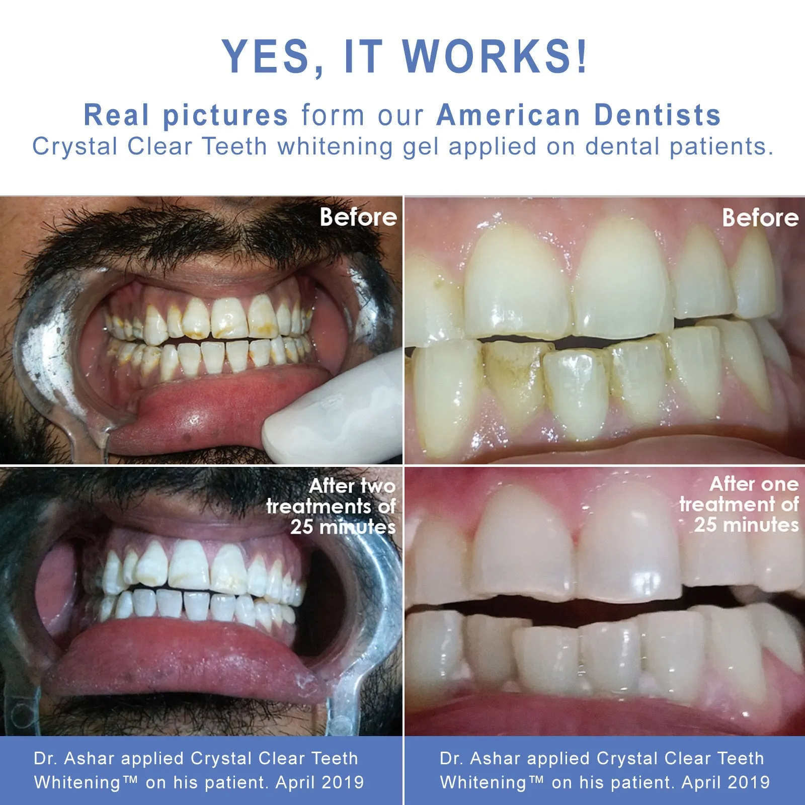 Crystal Clear Teeth Whitening US Dentists-Approved, Rechargeable Waterproof Teeth Whitening All-in-One Kit