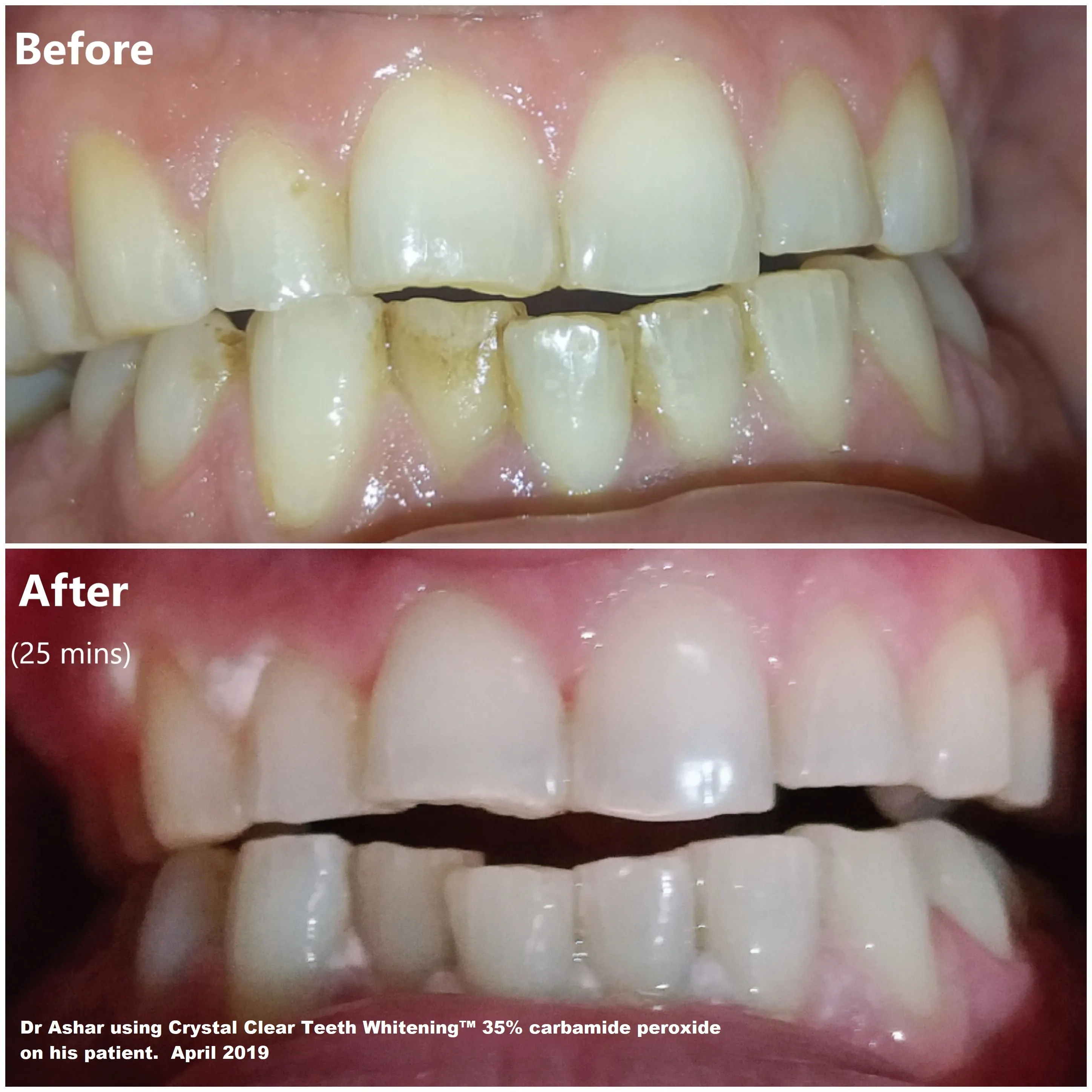 Crystal Clear Teeth Whitening US Dentists-Approved, Rechargeable Waterproof Teeth Whitening All-in-One Kit