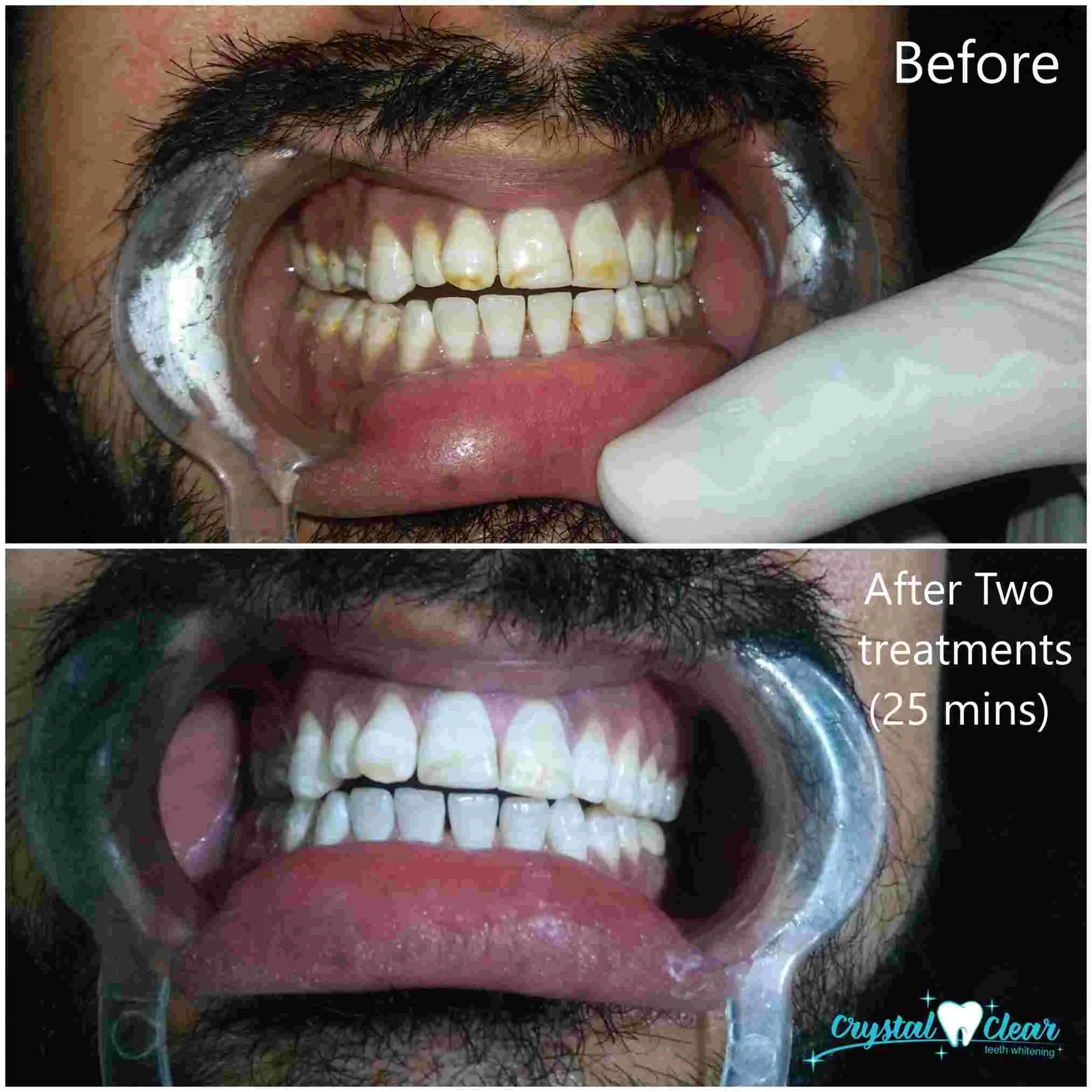 Crystal Clear Teeth Whitening US Dentists-Approved, Rechargeable Waterproof Teeth Whitening All-in-One Kit