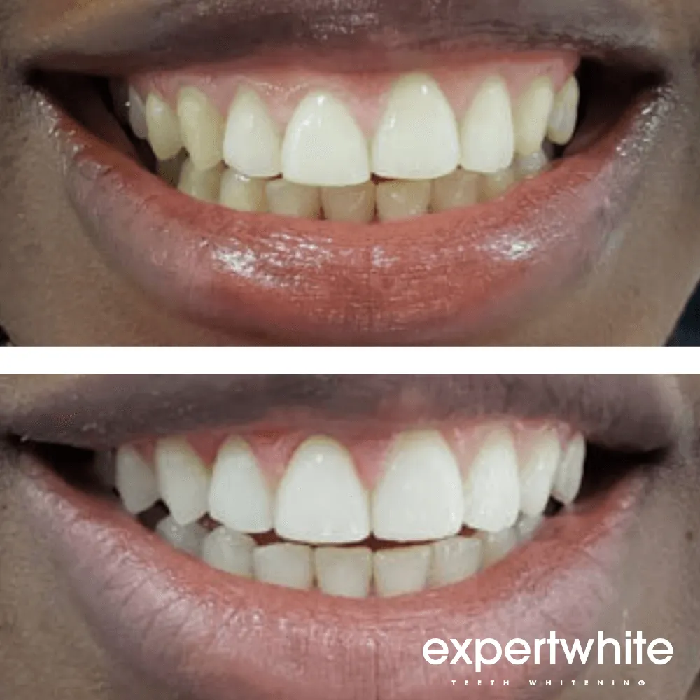 Expertwhite Max Pro-Whitening Complete Kit
