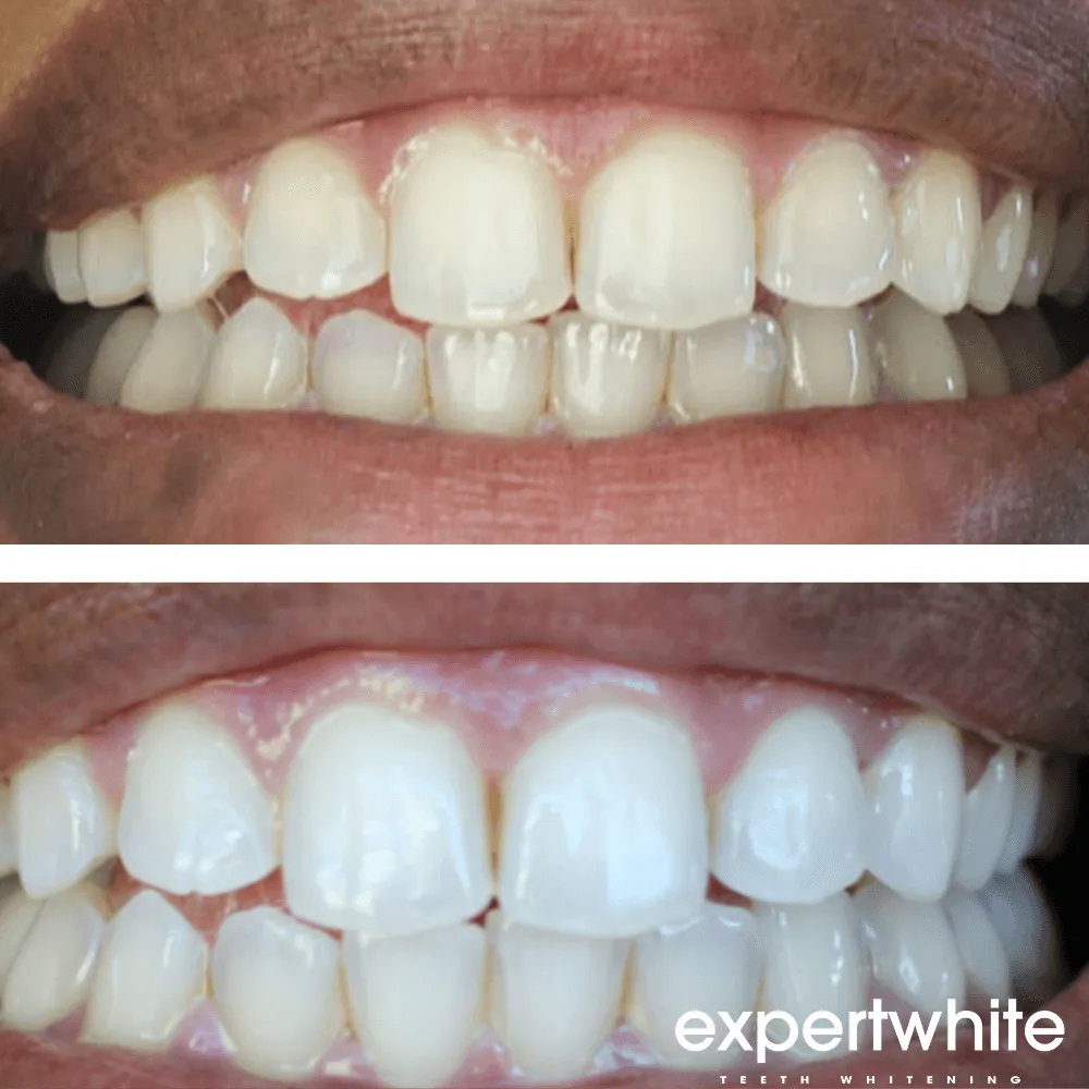 Expertwhite Max Pro-Whitening Complete Kit