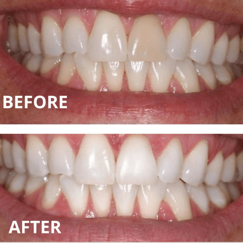 Expertwhite Max Pro-Whitening Complete Kit