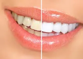 LED Teeth Whitening Machine