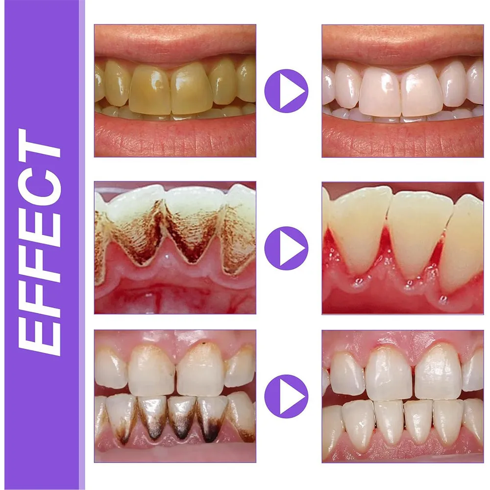 (NET) Teeth Whitening Mousse Removes Stubborn Stains 30ml