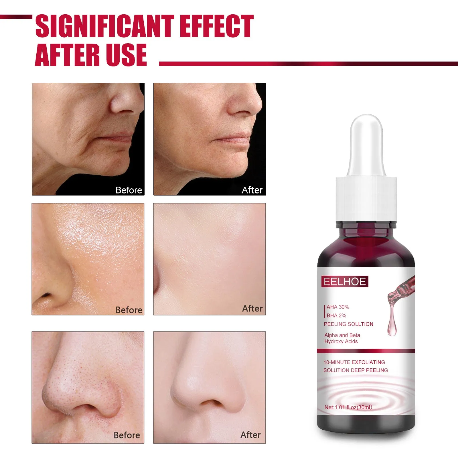Tartaric Acid Salicylic Acid Essence Exfoliating Closed Blackhead Acne Pore Shrinking Essence